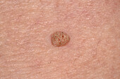 Filiform wart on a woman's knee