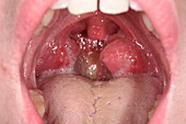 Tonsillitis in a boy's throat