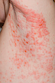Rash from chickenpox on a girl's trunk