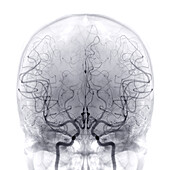 Cerebral arteries, angiogram