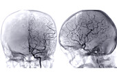 Cerebral arteries, angiograms