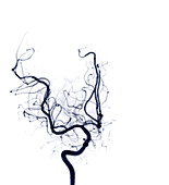 Cerebral arteries, angiogram