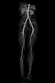 Torso and leg arteries, CT scan