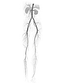 Torso and leg arteries, CT scan