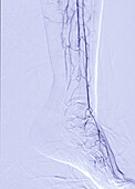 Lower leg and foot arteries, CT scan