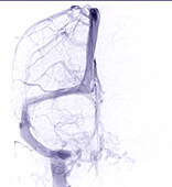 Cerebral veins, MRV scan