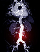 Stent in aortic aneurysm, CT scan