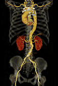 Human torso, CT scan