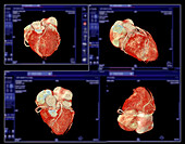 Healthy coronary arteries, CT scans