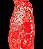 Pulmonary artery, CT scan