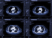 Pulmonary artery, CT scans