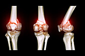 Fractured knee, CT scans