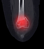Fractured knee, CT scan