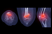 Fractured knee, CT scans