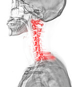 Neck pain, conceptual X-ray