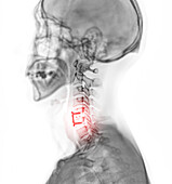 Pinned neck, X-ray