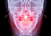 Upper neck pain, conceptual X-ray