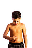 Boy with chickenpox