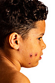 Boy with chickenpox