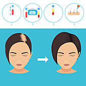 PRP hair loss treatment, illustration