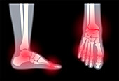 Arthritis of the foot, conceptual illustration
