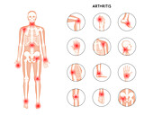 Arthritis, conceptual illustration