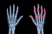 Healthy and arthritic hands, conceptual illustration