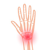 Wrist pain, conceptual illustration