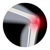 Arthritis of the knee, conceptual illustration