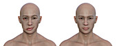 Healthy man and man with facial palsy, illustration