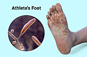 Athlete's foot, illustration