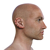 Ear lobomycosis nodules, illustration
