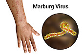 Rash in Marburg haemorrhagic fever, illustration