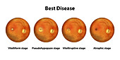 Stages of Best vitelliform macular dystrophy, illustration