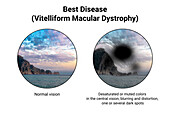 Normal eye and an eye with Best disease, illustration