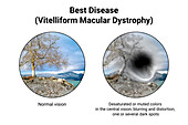 Normal eye and an eye with Best disease, illustration