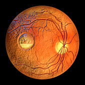 Best vitelliform macular dystrophy, illustration