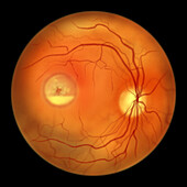 Best vitelliform macular dystrophy, illustration