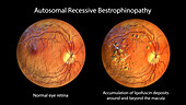 Autosomal recessive bestrophinopathy, illustration