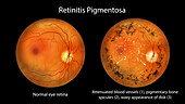 Retinitis pigmentosa, illustration