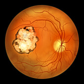 Retinal scar caused by toxoplasmosis, illustration