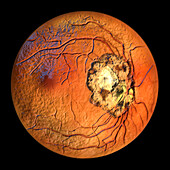 Retinal scar caused by toxoplasmosis, illustration