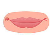 Angular cheilitis, illustration