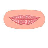 Dry lips, illustration