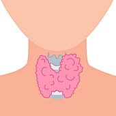 Enlarged thyroid gland, illustration