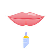 Lip augmentation, illustration
