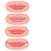 Lip disorders, illustration