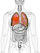 Lung cancer, illustration