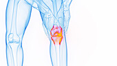 Knee pain, illustration