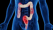 Inflamed colon, illustration